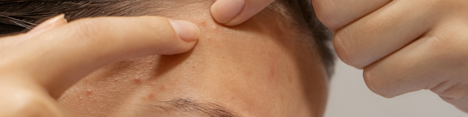 close up of a face with a few pimples